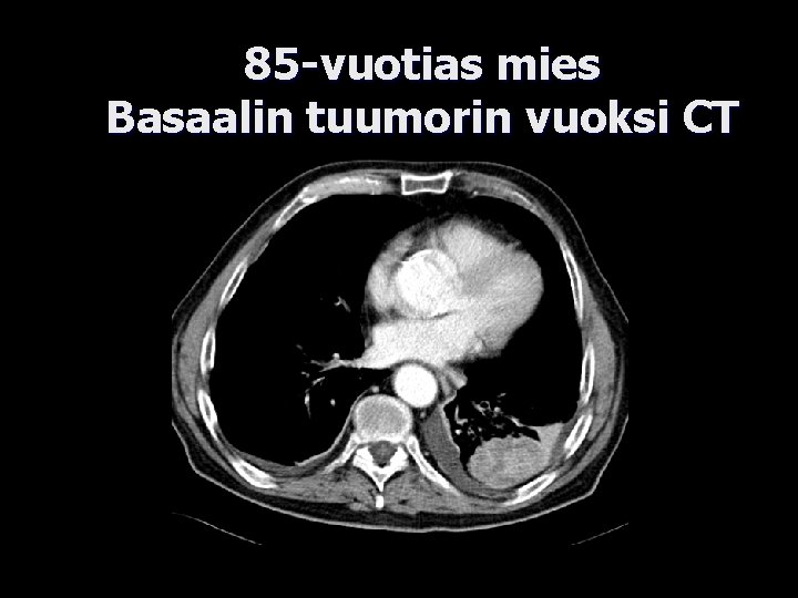 85 -vuotias mies Basaalin tuumorin vuoksi CT 