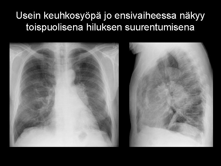 Usein keuhkosyöpä jo ensivaiheessa näkyy toispuolisena hiluksen suurentumisena 