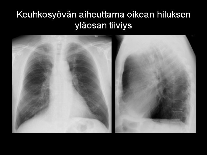 Keuhkosyövän aiheuttama oikean hiluksen yläosan tiiviys 