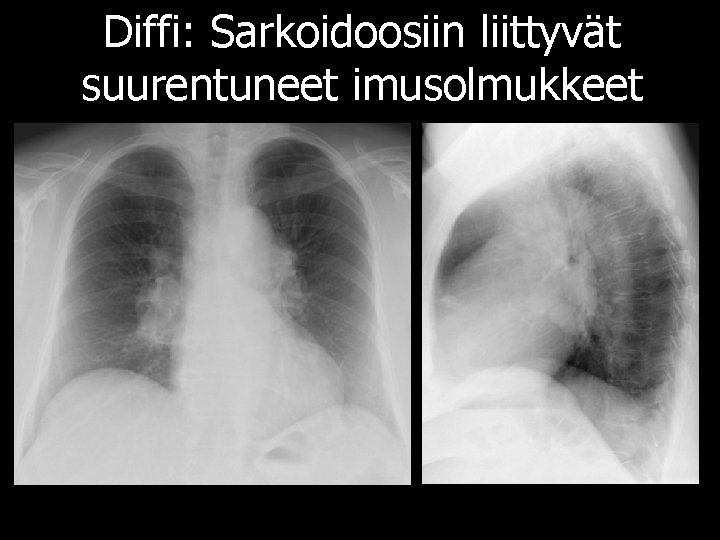 Diffi: Sarkoidoosiin liittyvät suurentuneet imusolmukkeet 