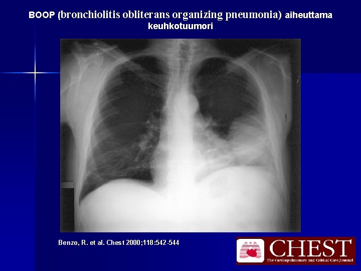 BOOP (bronchiolitis obliterans organizing pneumonia) aiheuttama keuhkotuumori Benzo, R. et al. Chest 2000; 118: