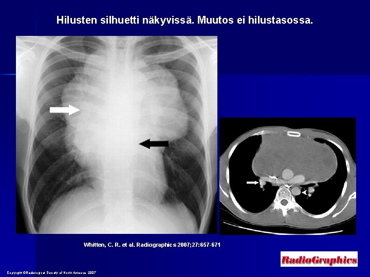 Hilusten silhuetti näkyvissä. Muutos ei hilustasossa. Whitten, C. R. et al. Radiographics 2007; 27: