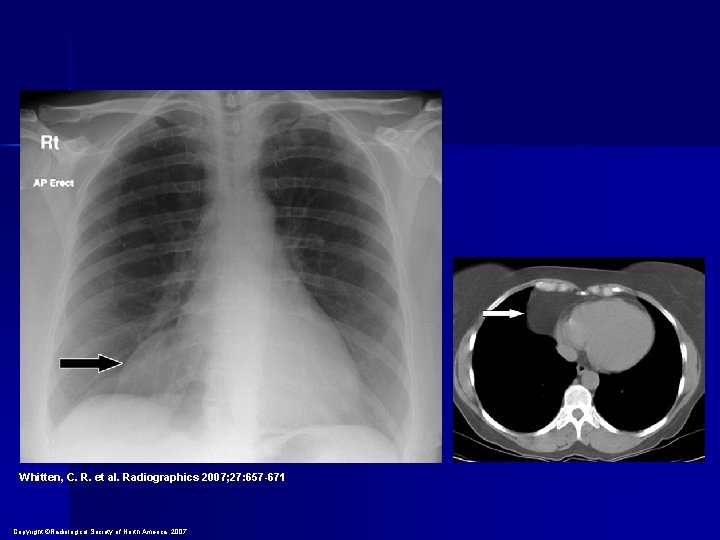 Whitten, C. R. et al. Radiographics 2007; 27: 657 -671 Copyright ©Radiological Society of