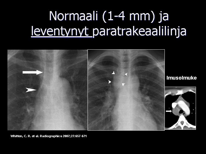 Normaali (1 -4 mm) ja leventynyt paratrakeaalilinja Imusolmuke Whitten, C. R. et al. Radiographics