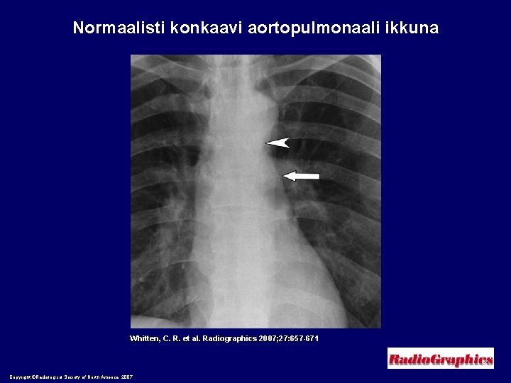 Normaalisti konkaavi aortopulmonaali ikkuna Whitten, C. R. et al. Radiographics 2007; 27: 657 -671