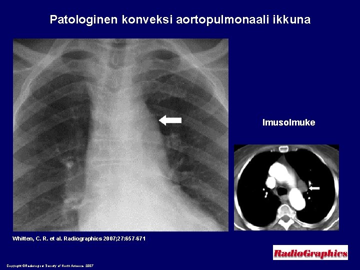 Patologinen konveksi aortopulmonaali ikkuna Imusolmuke Whitten, C. R. et al. Radiographics 2007; 27: 657