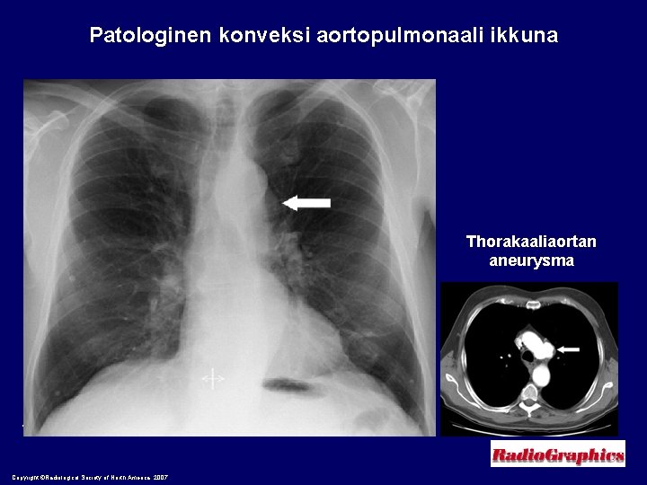 Patologinen konveksi aortopulmonaali ikkuna Thorakaaliaortan aneurysma Whitten, C. R. et al. Radiographics 2007; 27:
