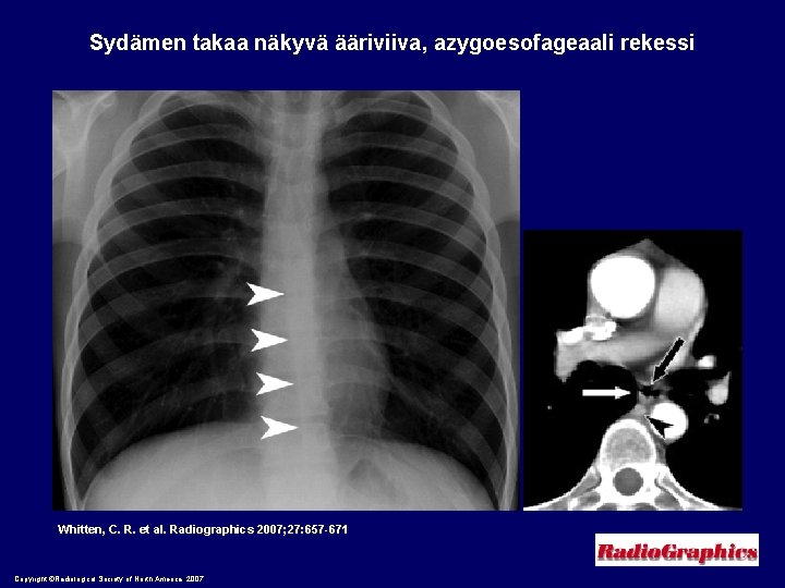 Sydämen takaa näkyvä ääriviiva, azygoesofageaali rekessi Whitten, C. R. et al. Radiographics 2007; 27: