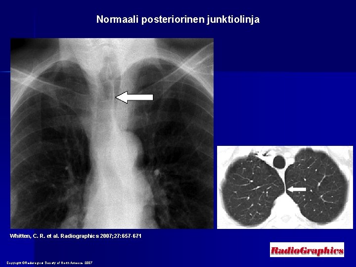 Normaali posteriorinen junktiolinja Whitten, C. R. et al. Radiographics 2007; 27: 657 -671 Copyright