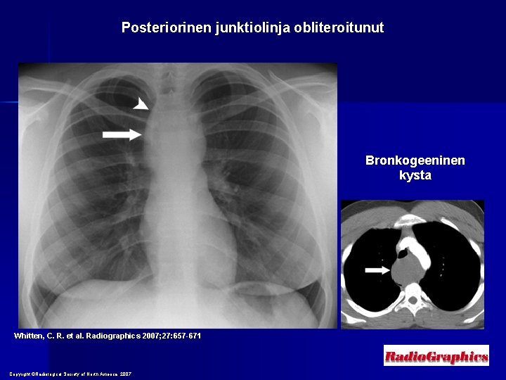 Posteriorinen junktiolinja obliteroitunut Bronkogeeninen kysta Whitten, C. R. et al. Radiographics 2007; 27: 657