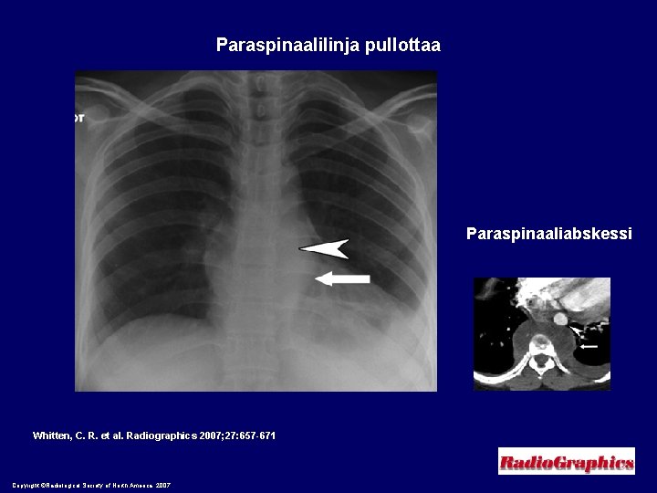Paraspinaalilinja pullottaa Paraspinaaliabskessi Whitten, C. R. et al. Radiographics 2007; 27: 657 -671 Copyright