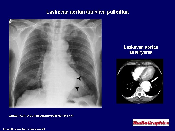 Laskevan aortan ääriviiva pulloittaa Laskevan aortan aneurysma Whitten, C. R. et al. Radiographics 2007;
