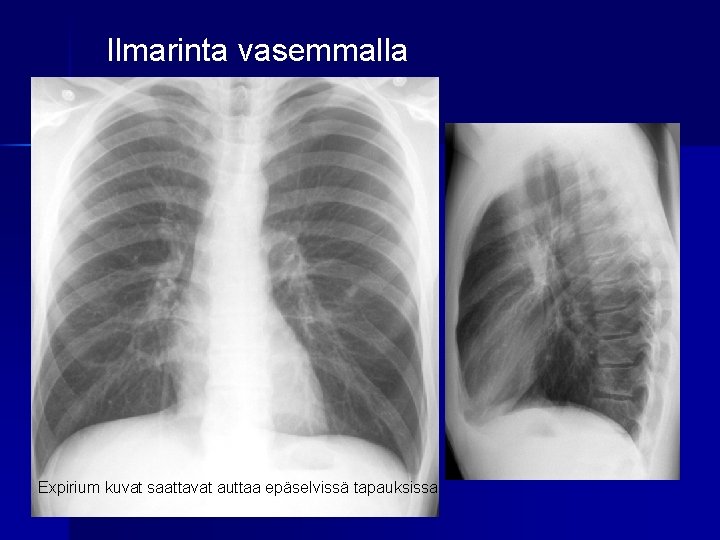 Ilmarinta vasemmalla Expirium kuvat saattavat auttaa epäselvissä tapauksissa 