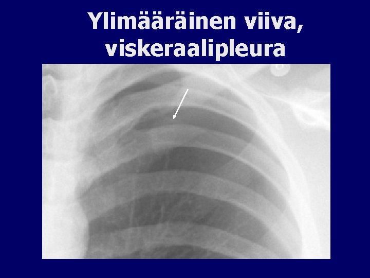 Ylimääräinen viiva, viskeraalipleura 