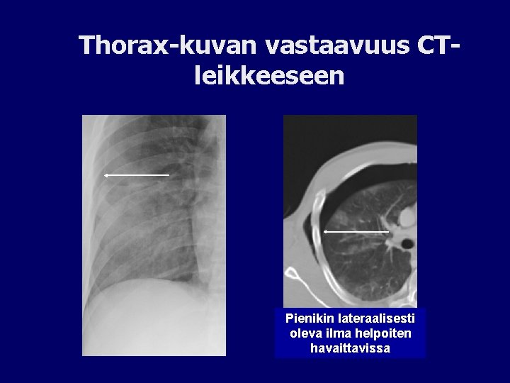 Thorax-kuvan vastaavuus CTleikkeeseen Pienikin lateraalisesti oleva ilma helpoiten havaittavissa 