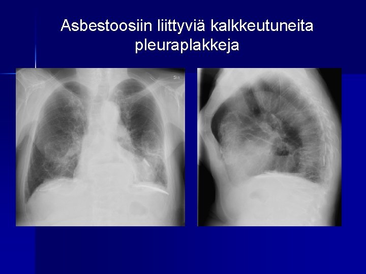 Asbestoosiin liittyviä kalkkeutuneita pleuraplakkeja 