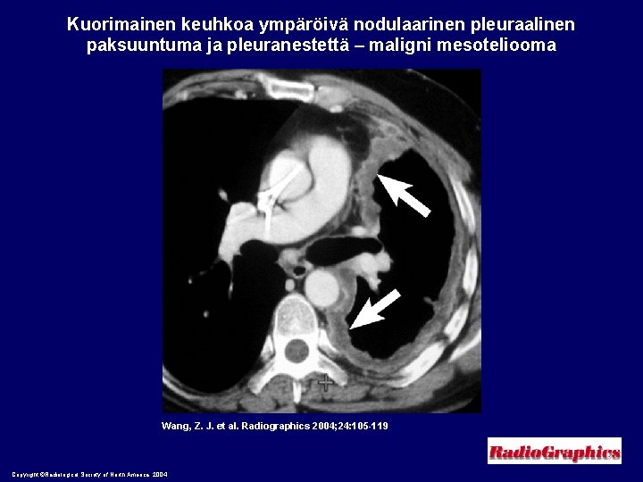 Kuorimainen keuhkoa ympäröivä nodulaarinen pleuraalinen paksuuntuma ja pleuranestettä – maligni mesoteliooma Wang, Z. J.