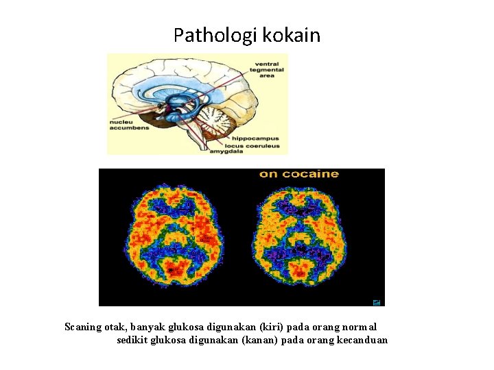 Pathologi kokain Scaning otak, banyak glukosa digunakan (kiri) pada orang normal sedikit glukosa digunakan