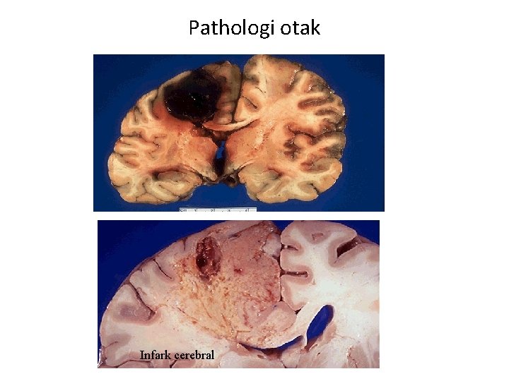 Pathologi otak Otak mengalami perdarahan Infark cerebral 