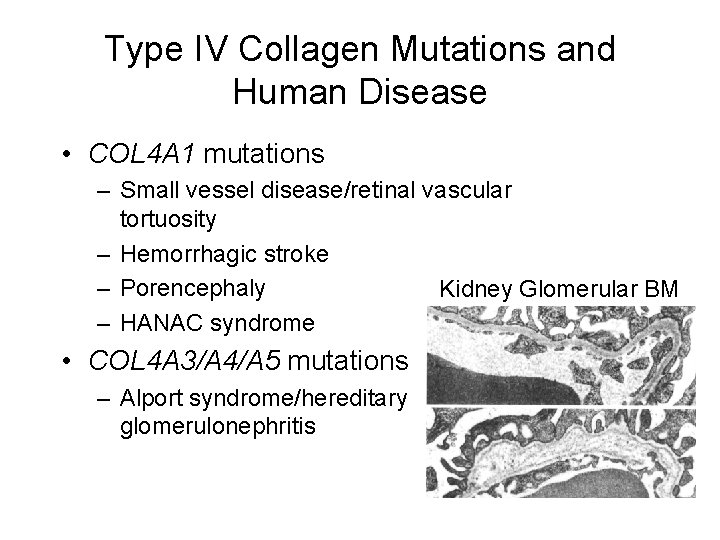 Type IV Collagen Mutations and Human Disease • COL 4 A 1 mutations –