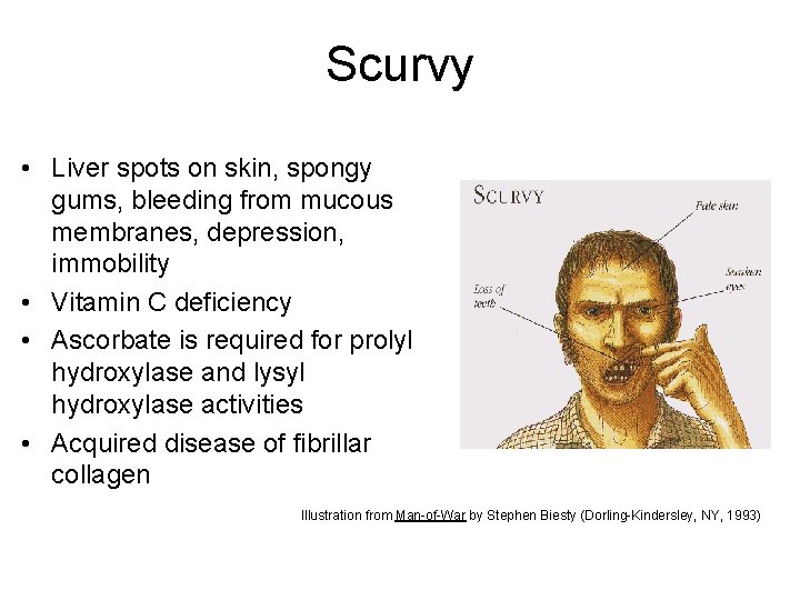 Scurvy • Liver spots on skin, spongy gums, bleeding from mucous membranes, depression, immobility