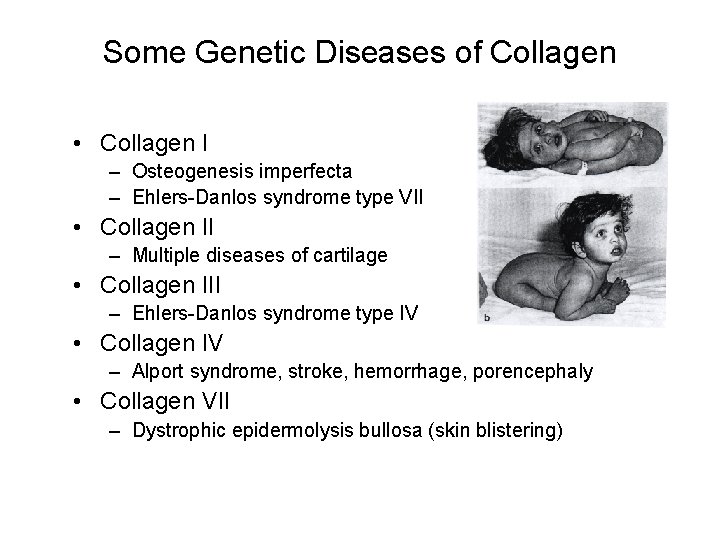 Some Genetic Diseases of Collagen • Collagen I – Osteogenesis imperfecta – Ehlers-Danlos syndrome