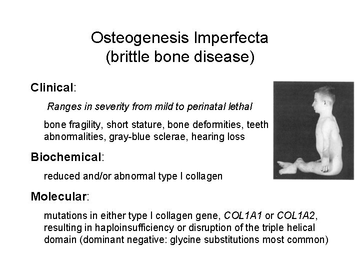 Osteogenesis Imperfecta (brittle bone disease) Clinical: Ranges in severity from mild to perinatal lethal