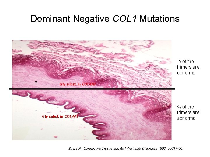 Dominant Negative COL 1 Mutations ½ of the trimers are abnormal * Gly subst. Dominant Negative COL 1 Mutations ½ of the trimers are abnormal * Gly subst.