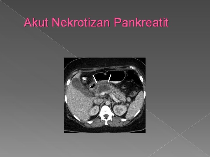 Akut Nekrotizan Pankreatit 