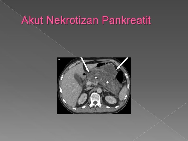 Akut Nekrotizan Pankreatit 