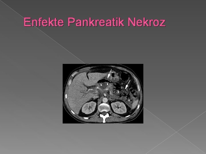 Enfekte Pankreatik Nekroz 