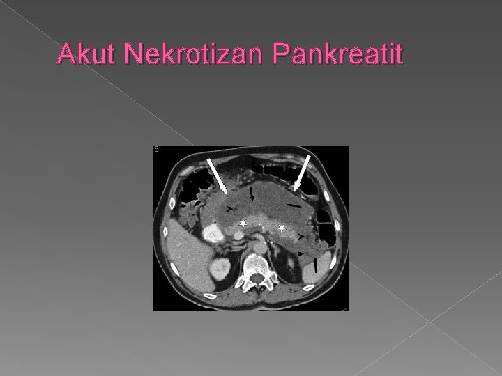 Akut Nekrotizan Pankreatit 