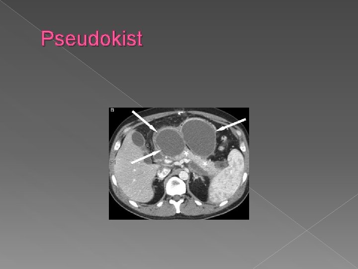 Pseudokist 