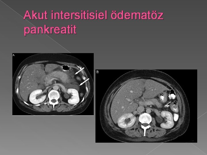 Akut intersitisiel ödematöz pankreatit 