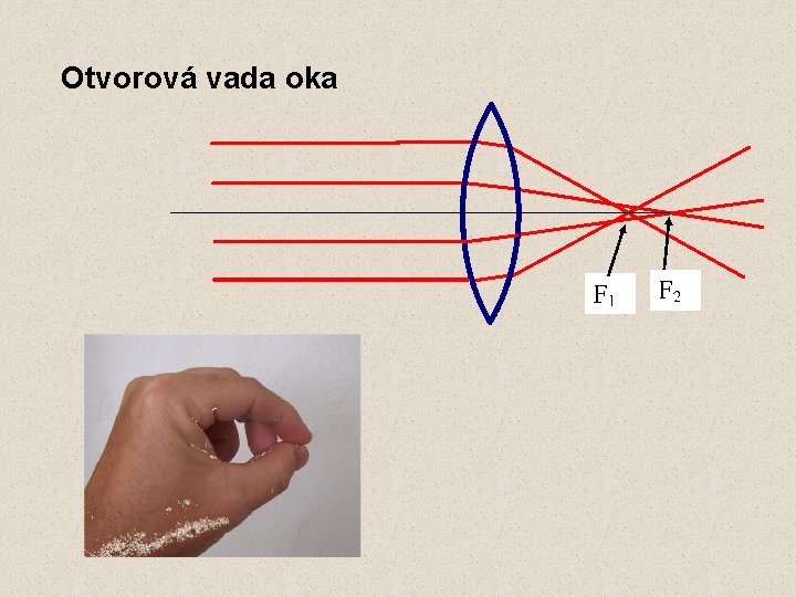 Otvorová vada oka 