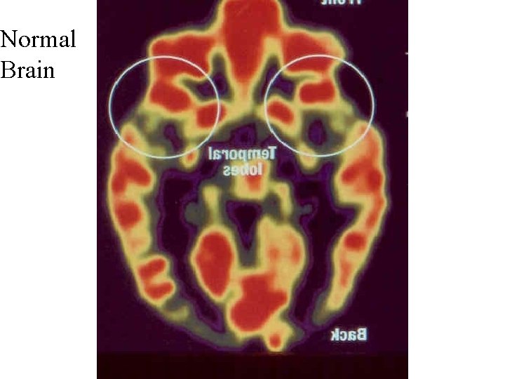 Normal Brain Normal Brain