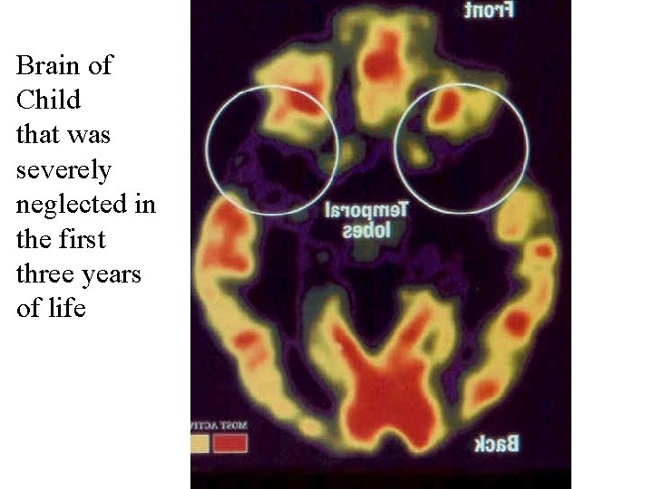 Brain of Child that was severely neglected in the first three years of life Brain of Child that was severely neglected in the first three years of life