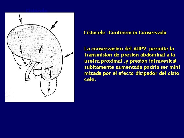 Cistocele : Continencia Conservada La conservacion del AUPV permite la transmision de presion abdominal