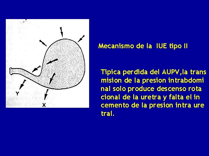 IUE Tipo II Mecanismo de la IUE tipo II Tipica perdida del AUPV, la