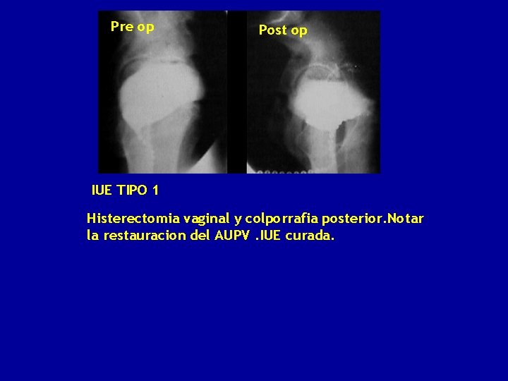 Pre op Post op IUE TIPO 1 Histerectomia vaginal y colporrafia posterior. Notar la