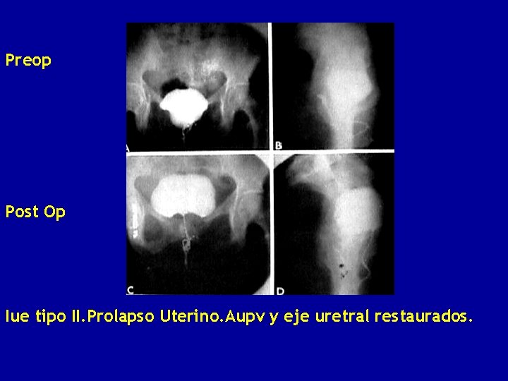 Preop Post Op Iue tipo II. Prolapso Uterino. Aupv y eje uretral restaurados. 