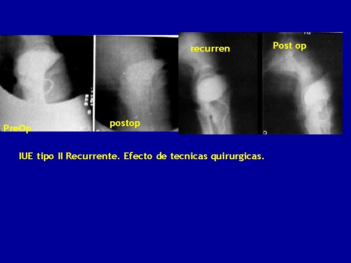 recurren Pre. Op postop IUE tipo II Recurrente. Efecto de tecnicas quirurgicas. Post op