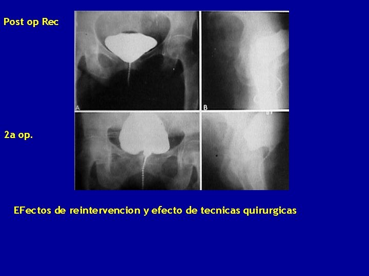 Post op Rec 2 a op. EFectos de reintervencion y efecto de tecnicas quirurgicas