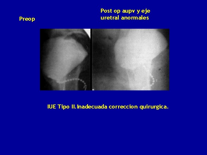 Preop Post op aupv y eje uretral anormales IUE Tipo II. Inadecuada correccion quirurgica.
