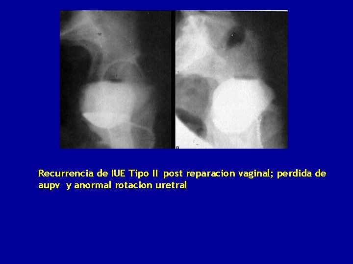 Recurrencia de IUE Tipo II post reparacion vaginal; perdida de aupv y anormal rotacion