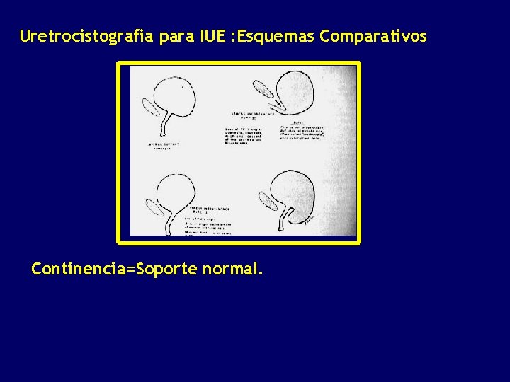 Uretrocistografia para IUE : Esquemas Comparativos Continencia=Soporte normal. 