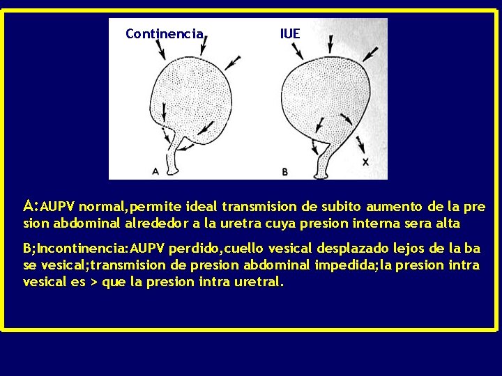 Continencia IUE A: AUPV normal, permite ideal transmision de subito aumento de la pre