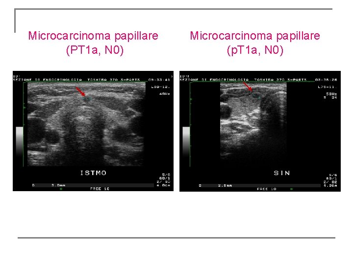 Microcarcinoma papillare (PT 1 a, N 0) Microcarcinoma papillare (p. T 1 a, N Microcarcinoma papillare (PT 1 a, N 0) Microcarcinoma papillare (p. T 1 a, N