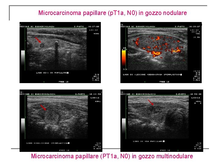 Microcarcinoma papillare (p. T 1 a, N 0) in gozzo nodulare Microcarcinoma papillare (PT Microcarcinoma papillare (p. T 1 a, N 0) in gozzo nodulare Microcarcinoma papillare (PT