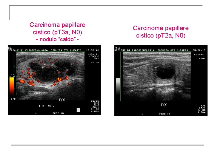 Carcinoma papillare cistico (p. T 3 a, N 0) - nodulo “caldo” - Carcinoma Carcinoma papillare cistico (p. T 3 a, N 0) - nodulo “caldo” - Carcinoma
